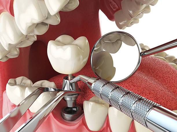 Best Emergency Dental Care for Broken or Chipped Teeth in Holtville, AL